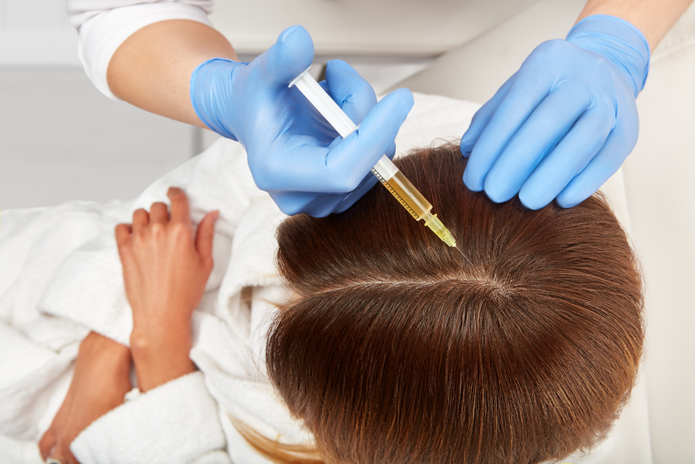 prp hair treatment